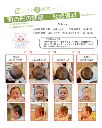 頭の形を治す