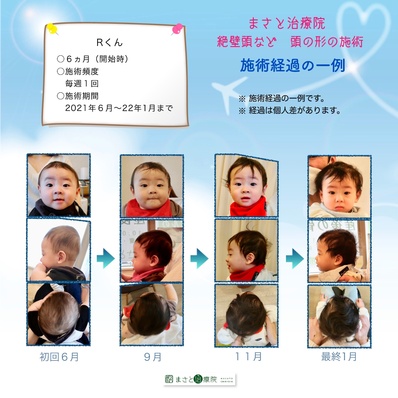 絶壁頭　あかちゃん