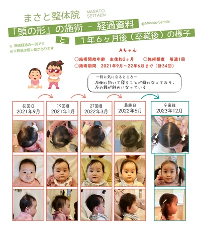 頭の形を治す