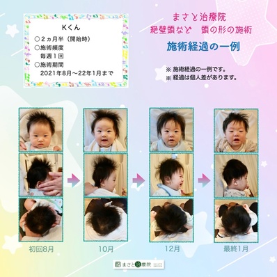斜頭症　検査
