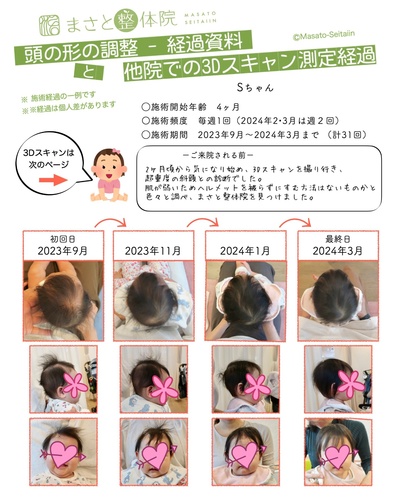斜頭を治す