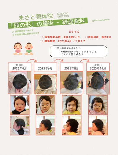 子どもの斜頭