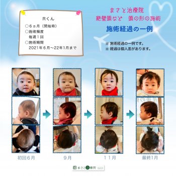 絶壁頭 あかちゃん