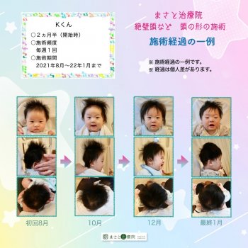 斜頭症 検査