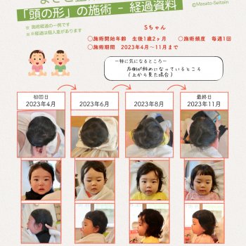 子どもの斜頭