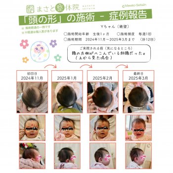 赤ちゃんの頭の形