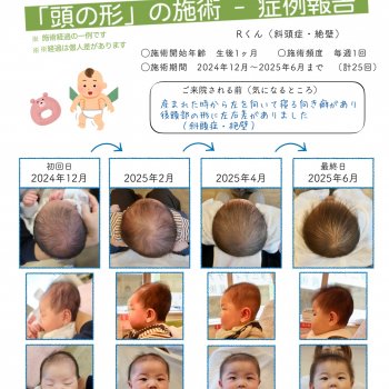 斜頭症 赤ちゃん