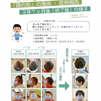 斜頭症