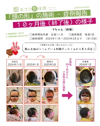 赤ちゃんの斜頭症