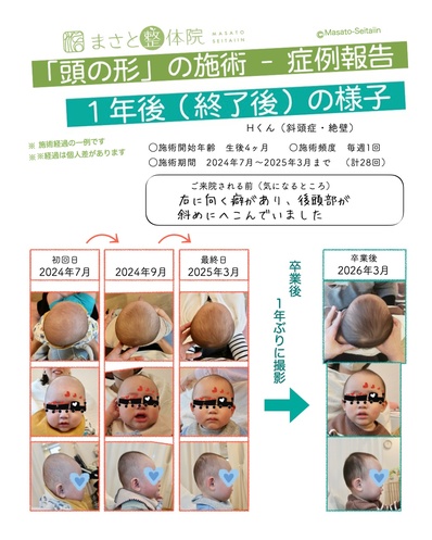 ヘルメット治療