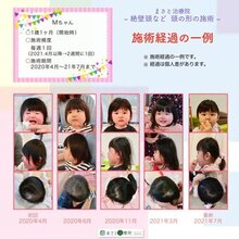 ヘルメット治療