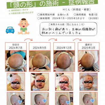赤ちゃん 頭の形