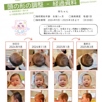 頭の形を治す